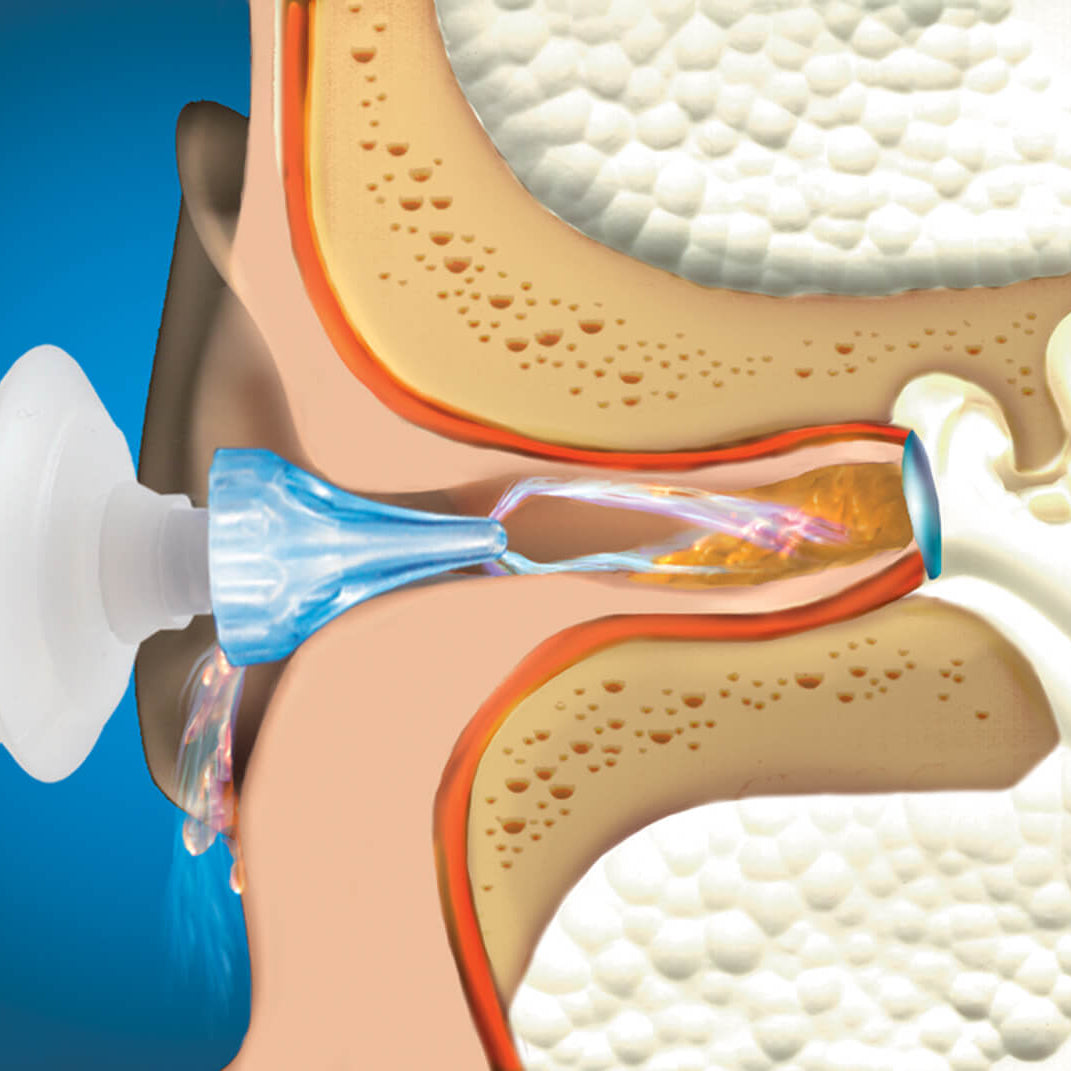 ProRinse Earwax Removal System Earplugs Mack's